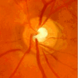 Progressive excavation of the optic nerve
