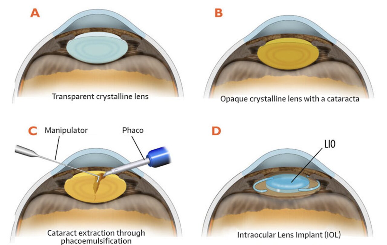 Phacoemulsification steps - cataract surgery